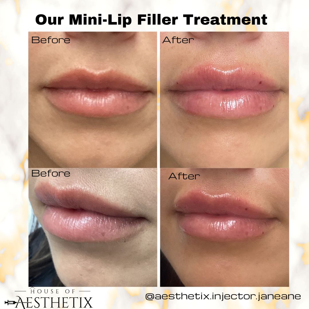 Luscious Lips 101: A Deep Dive into the World of Lip Fillers